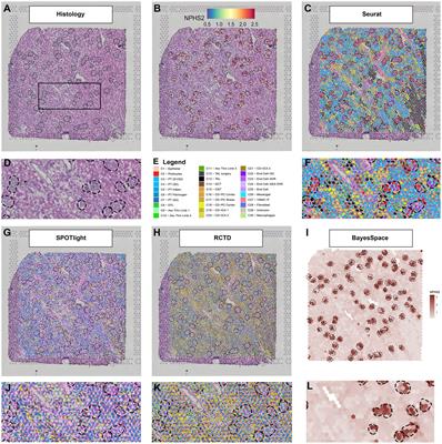 Deconvolution Tactics and Normalization in Renal Spatial Transcriptomics